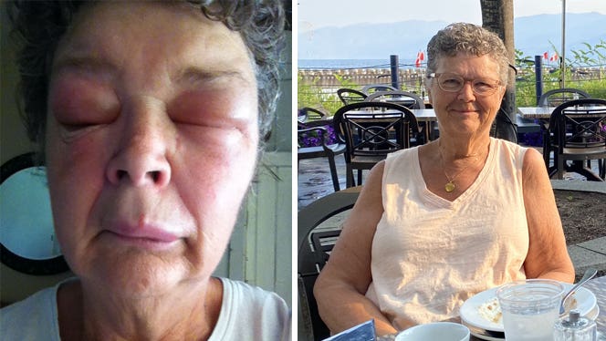 Wendy-Barto-before-and-after Wendy Barto shown before and after adopting a whole food plant based diet and healing from idiopathic angioedema: on the left, a close-up of her face with swollen eyelids, on the right, she sits outside at a cafe smiling, with no swelling