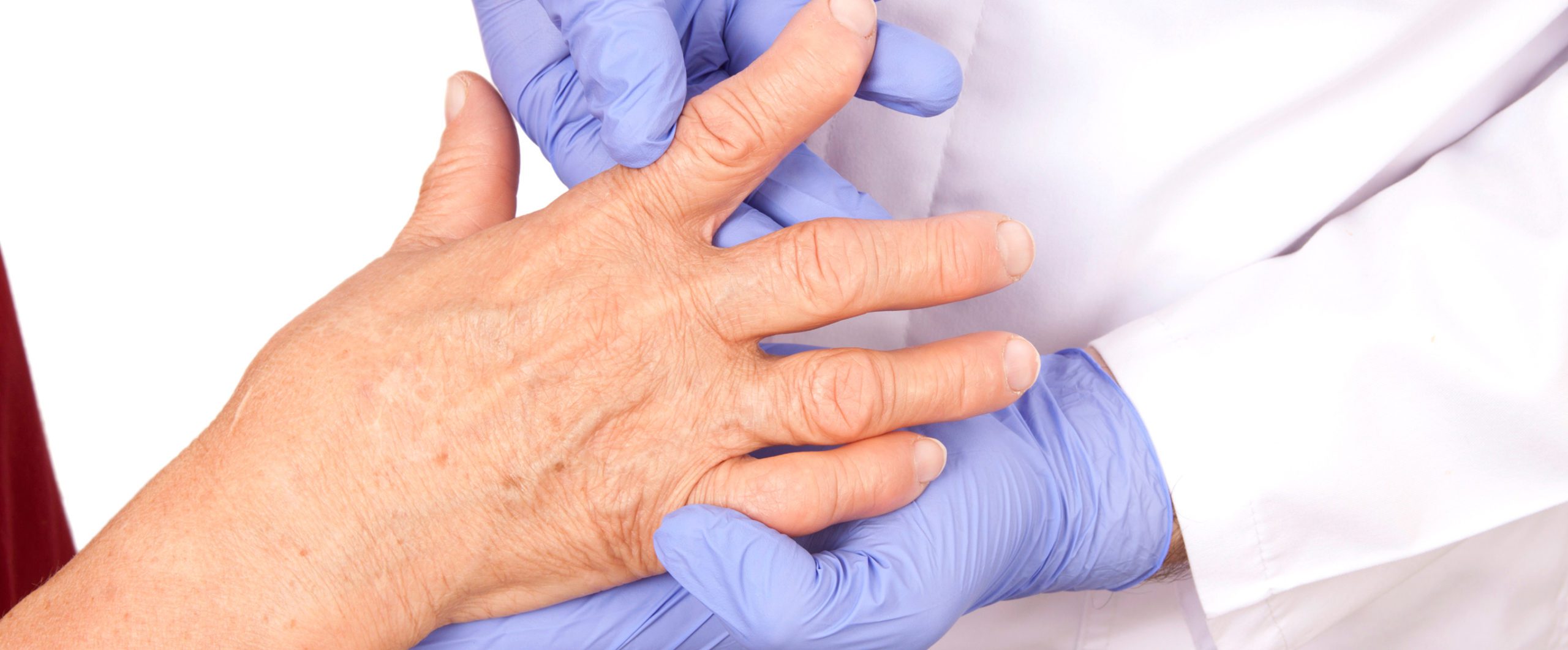 rheumatoid arthritis photo