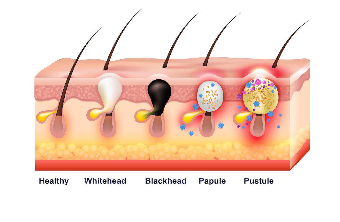 Types of Acne Pimples