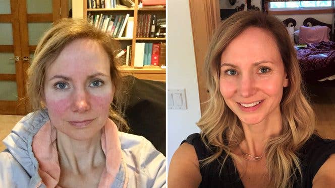 Kathy Meldrum before and after adopting a plant-based diet for rosacea: On the left, her cheeks are red and discolored; on the right, her skin is clear and healthy looking Kathy Meldrum before and after adopting a plant-based diet for rosacea: On the left, her cheeks are red and discolored; on the right, her skin is clear and healthy looking