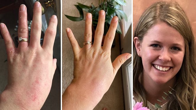 兩張照片顯示了女性在採用植物性飲食之前和之後的手。 在之前的照片中，手上有皮疹。 在之後的照片中，皮膚是透明的。
