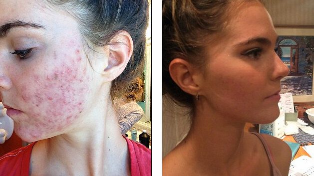 Before and after photos of Nina Nelson's cured cystic acne with the Forks Over Knives plant-based diet