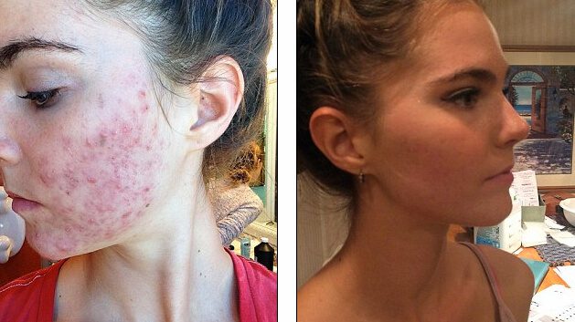 vegan diet causes acne