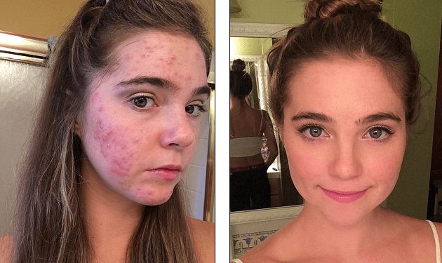 Before and after photos of how Nina and Randa Nelson cured cystic acne with the Forks Over Knives plant-based diet