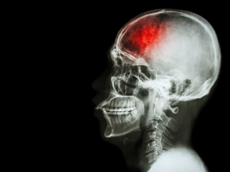 prevent stroke