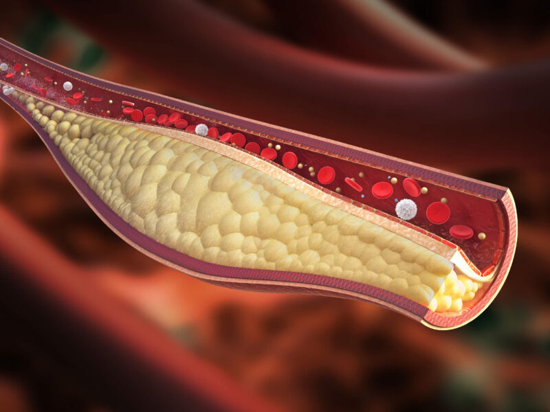 cholesterol diet