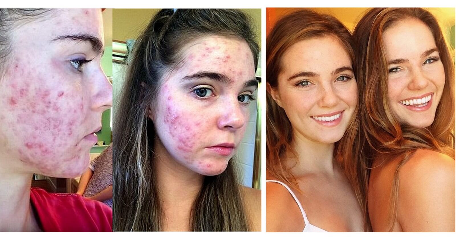 acne when changing diet